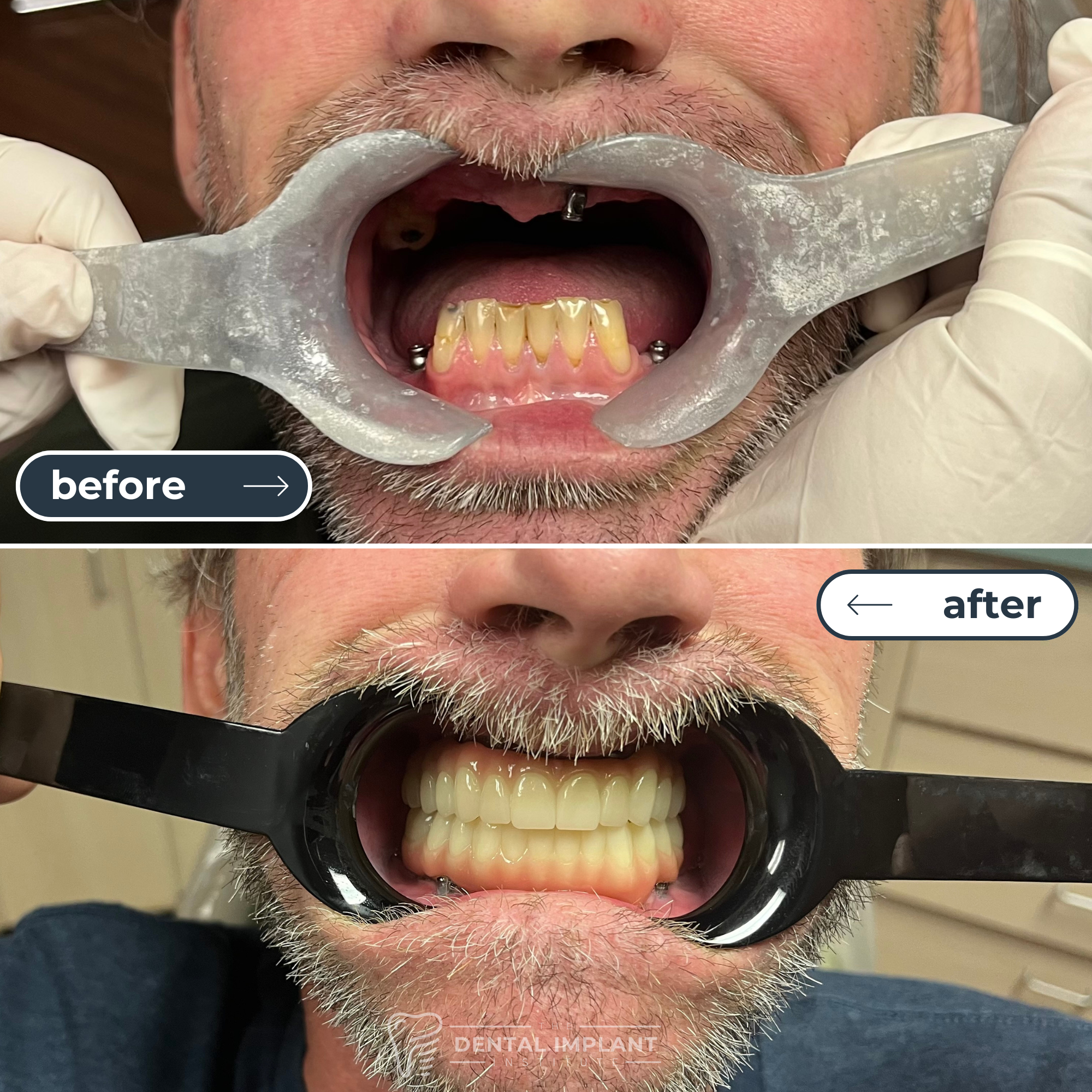 Before & After Dental Implant Institute