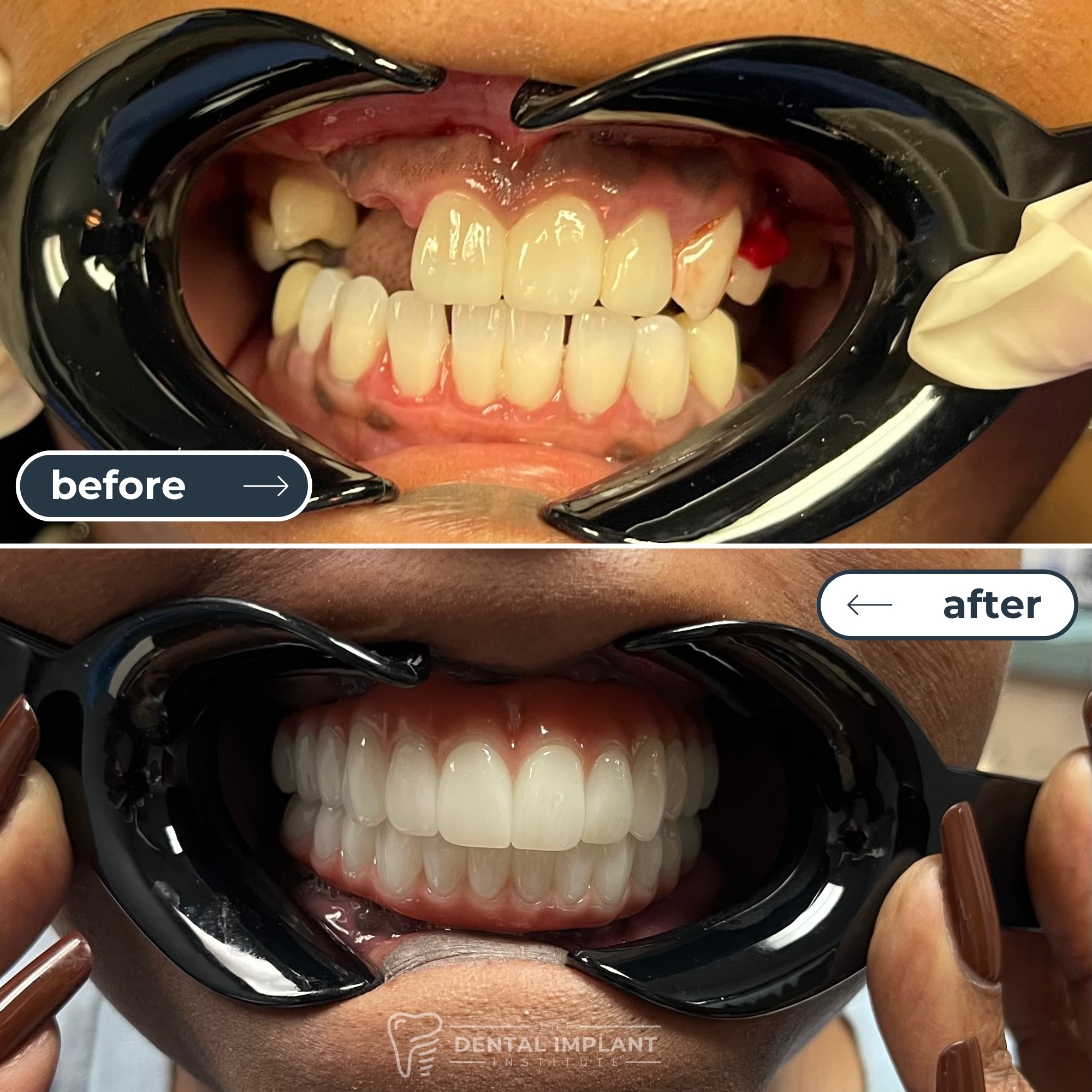 Before & After Dental Implant Institute (1)