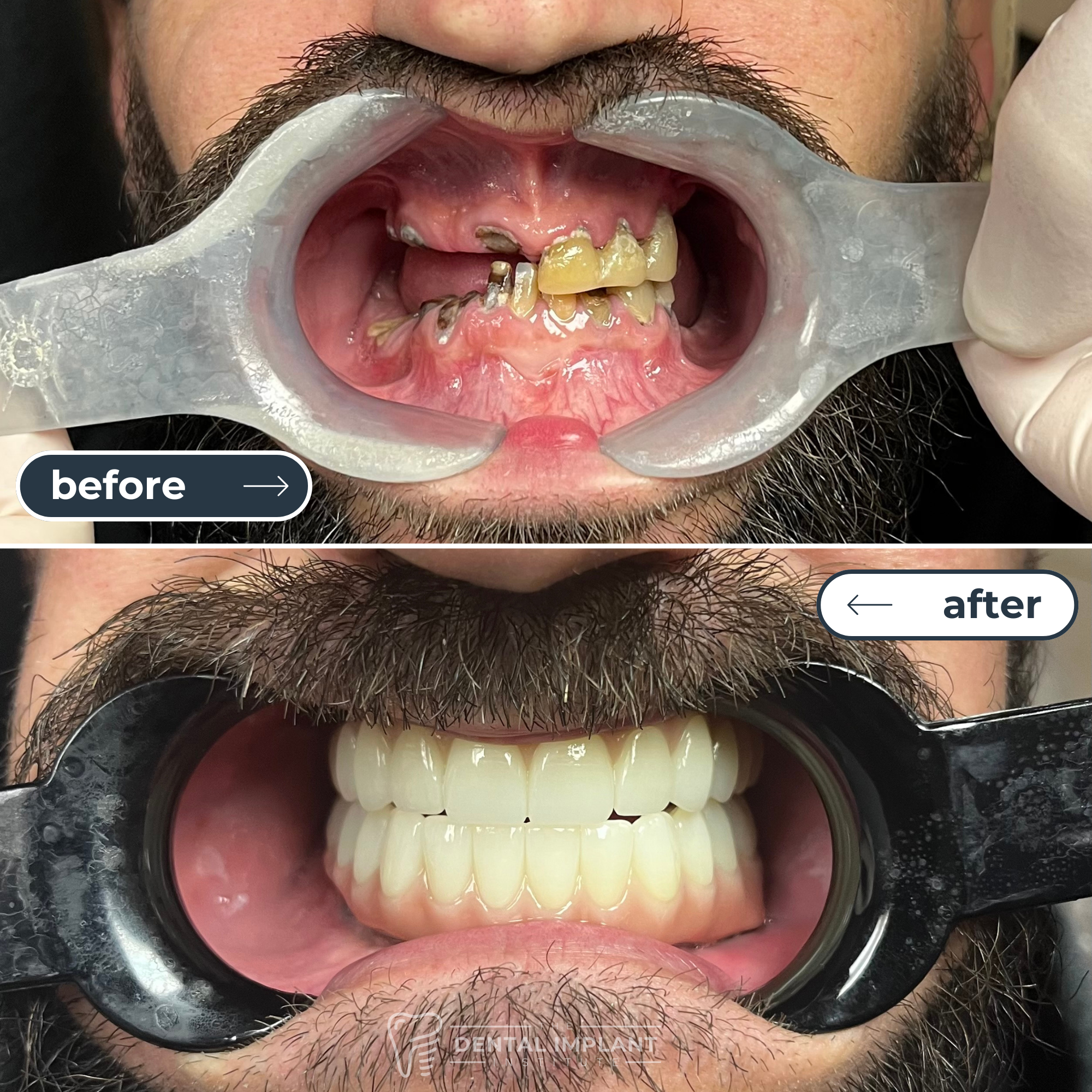 before___after__dental_implant_institute_
