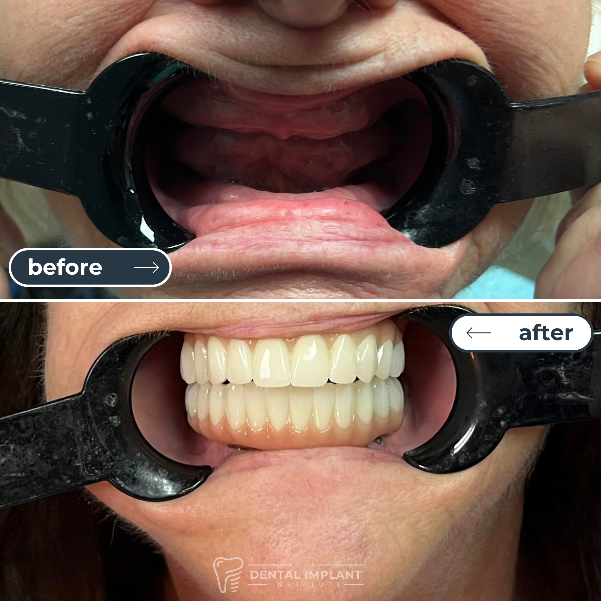 Before & After Dental Implant Institute (2)