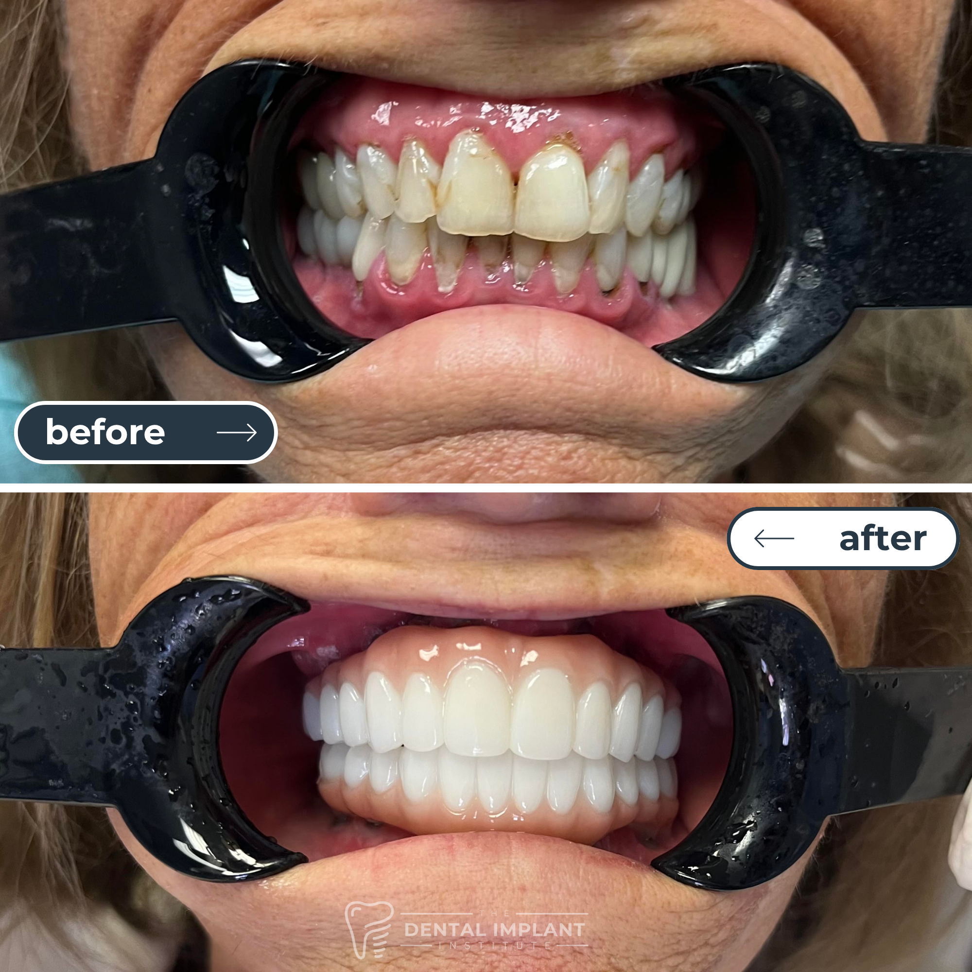 Before & After Dental Implant Institute (3)