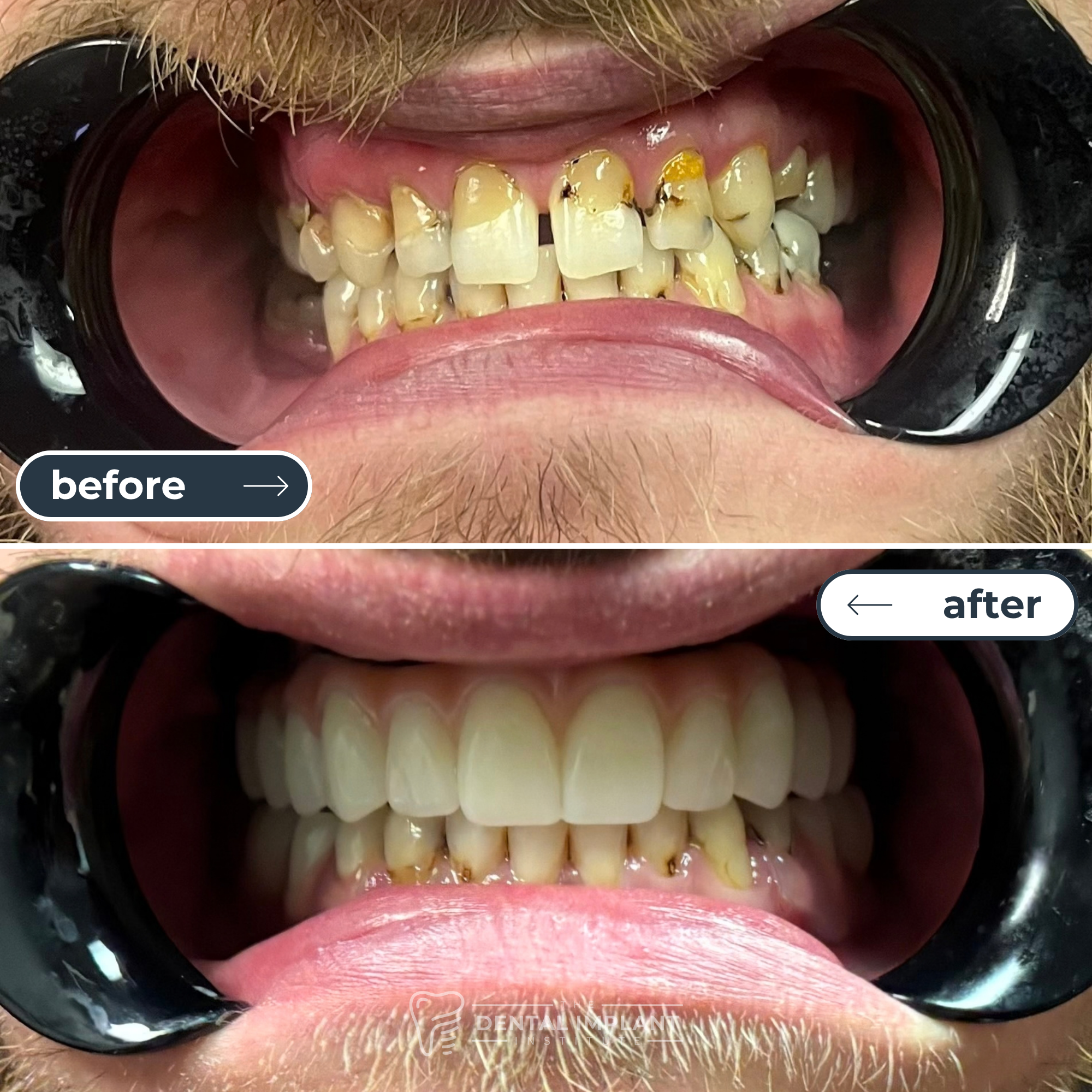 Before & After Dental Implant Institute (4)