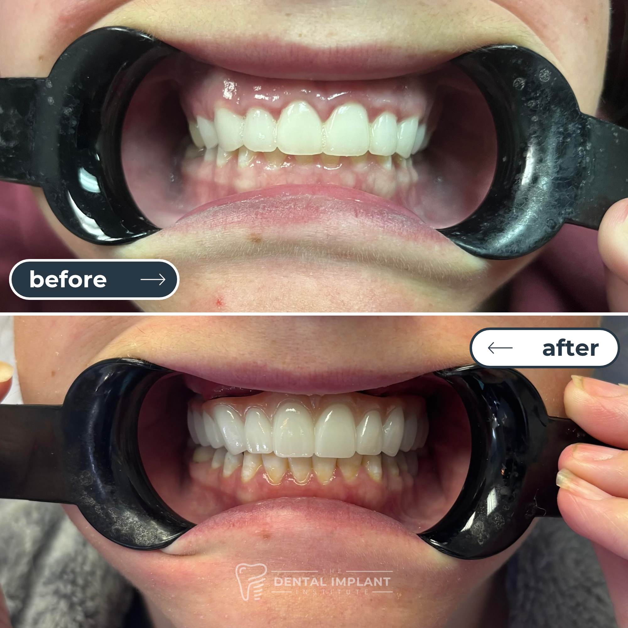 Before & After _ Dental Implant Institute